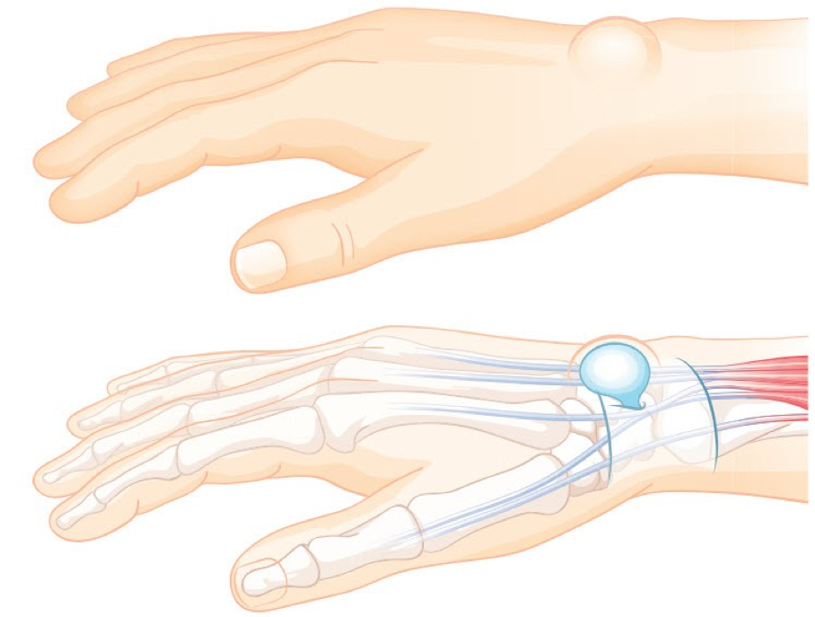 Kyste synovial du poignet