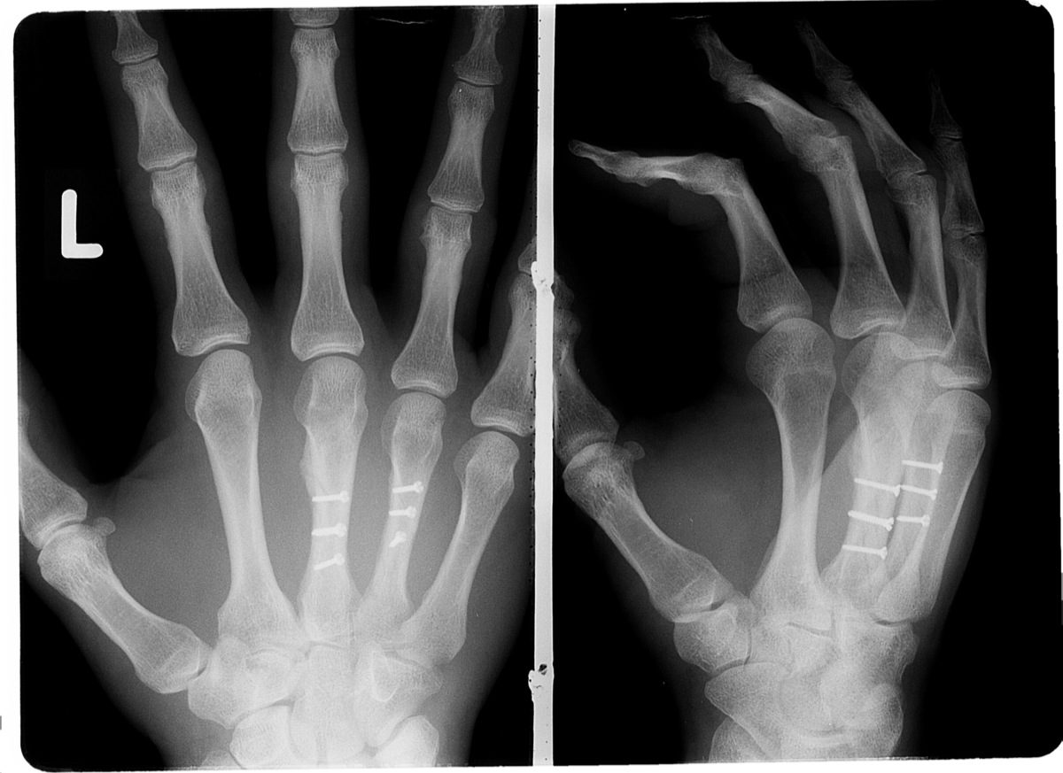 SGH_robinadams_handoperation_röntgenbild