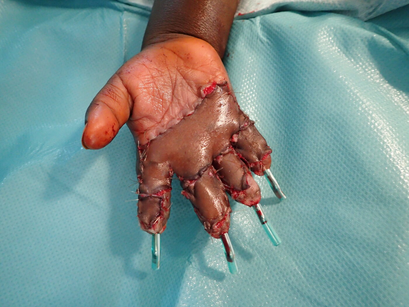 Interplast_Ghana_Handchirurgie_